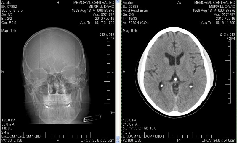 Click image for larger version

Name:	CAT Scan three stones.jpg
Views:	72
Size:	84.3 KB
ID:	578